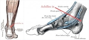 Achilles ín sérülés, gyulladás