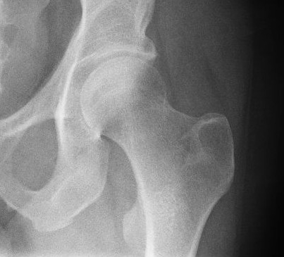 A csípő kopásos megbetegedése (coxarthrosis), A bal csípőízület deformáló artrózisa
