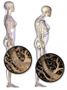 csontritkulas-osteoporosis-testtartas-cikk